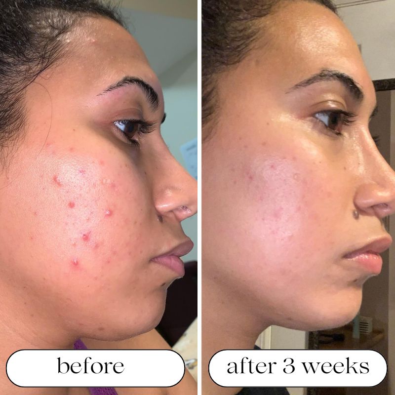 LumaDerm Pro LED-valoterapia-laite kosteutuksella