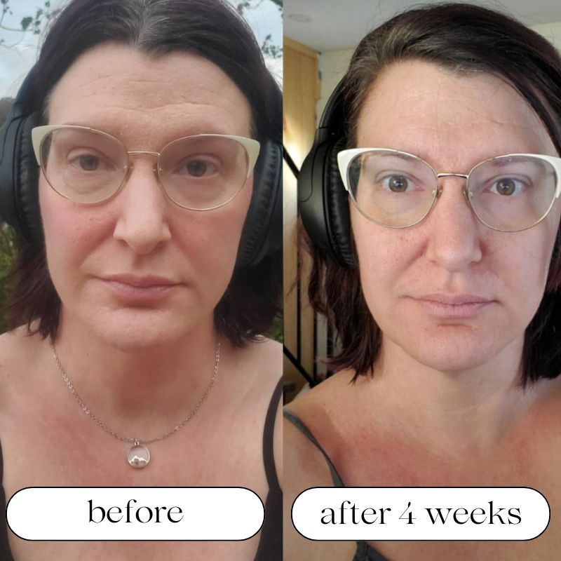 LumaDerm Pro LED-valoterapia-laite kosteutuksella