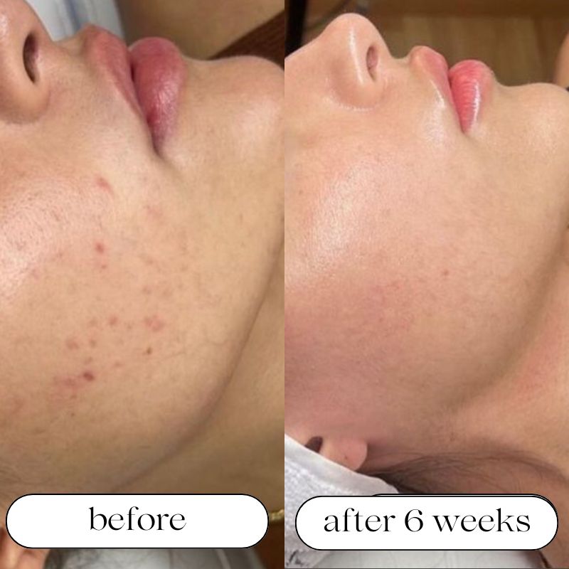 LumaDerm Pro LED-valoterapia-laite kosteutuksella