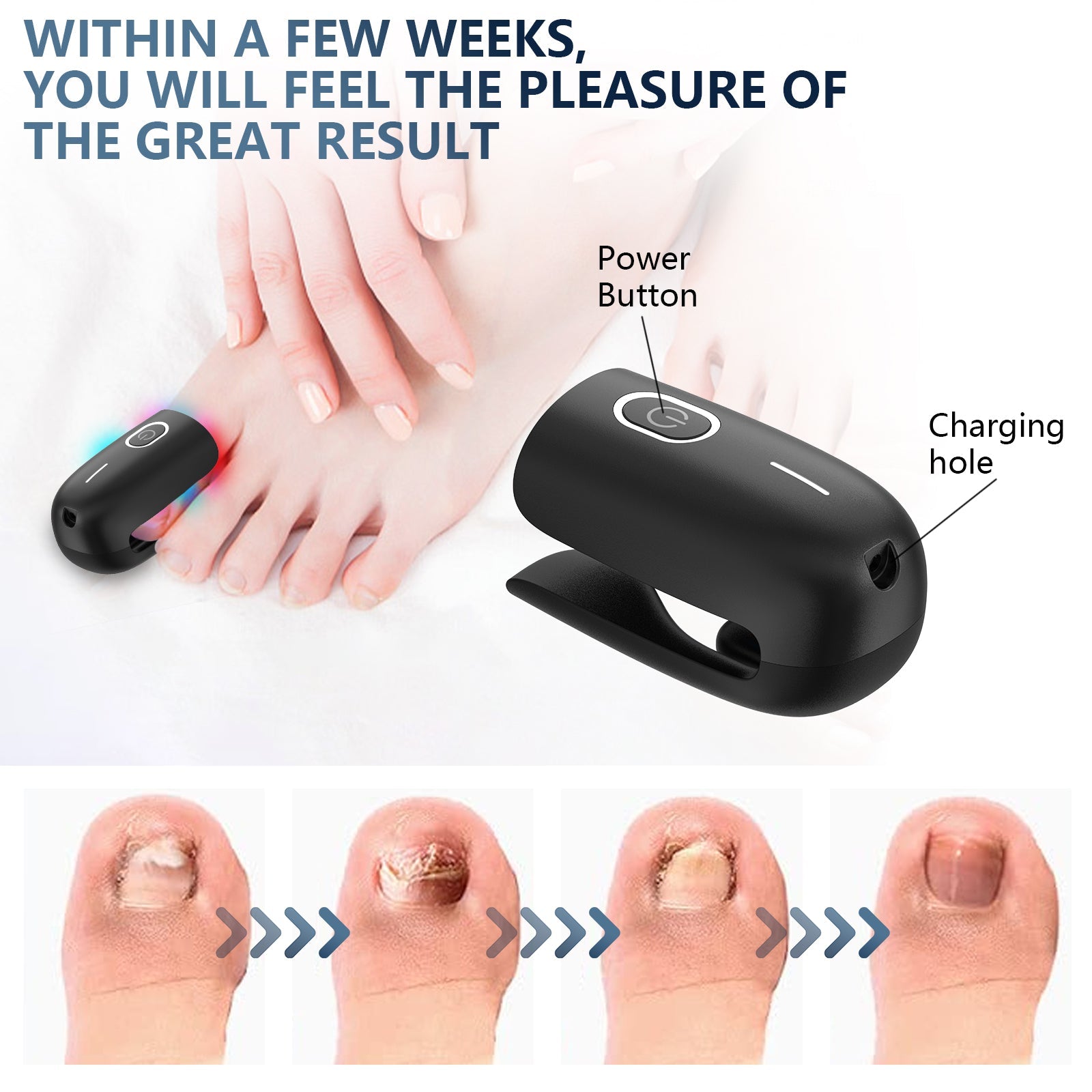 Urządzenie do laseroterapii grzybicy paznokci NailGuard do użytku domowego
