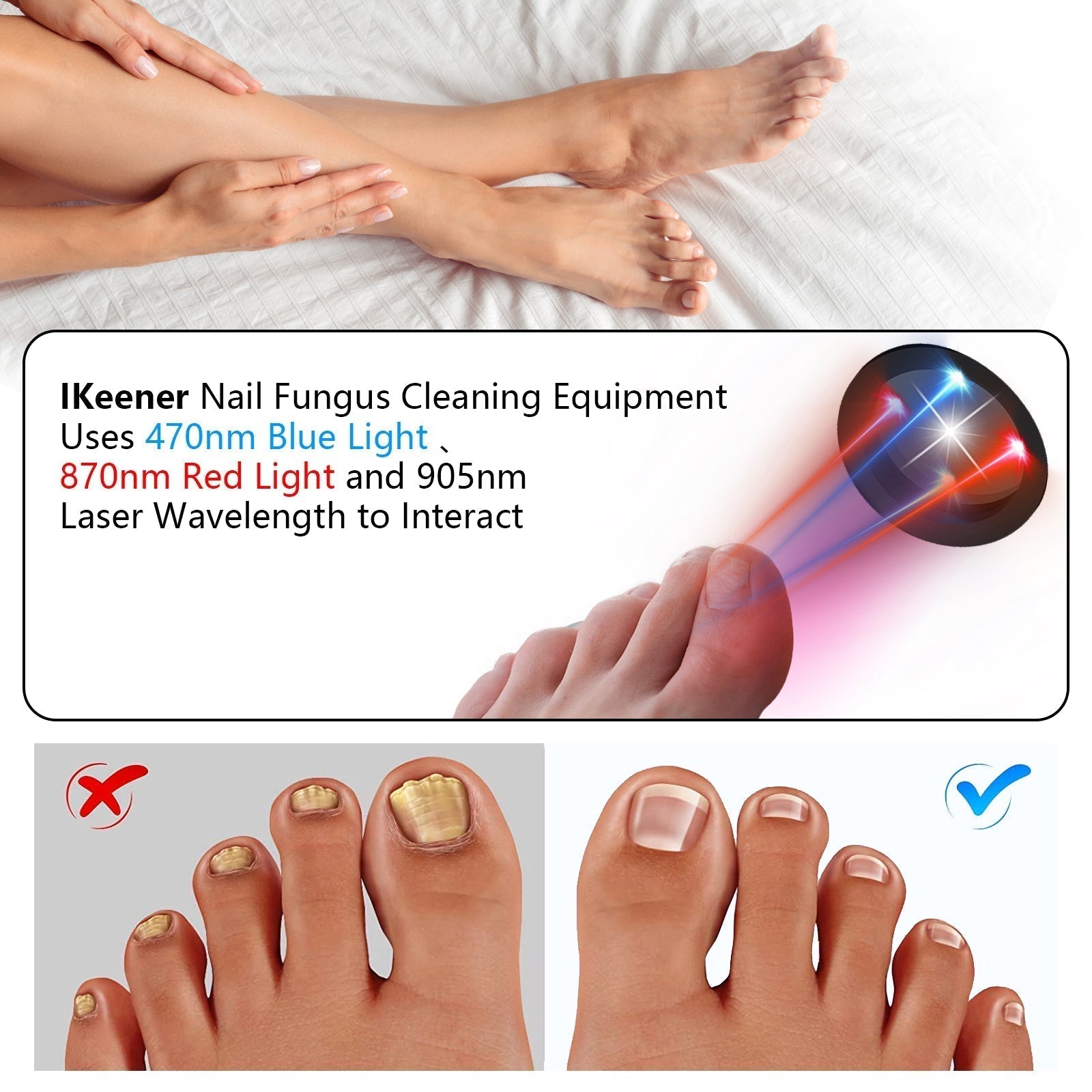 Urządzenie do laseroterapii grzybicy paznokci NailGuard do użytku domowego