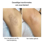 AureaNova IPL -karvavähennysjärjestelmä kotikäyttöön