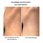 AureaNova IPL -karvavähennysjärjestelmä kotikäyttöön