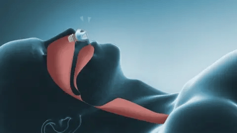 VeraPort Micro CPAP - Dispositivo Sem Máscara e Sem Fios para Apneia do Sono