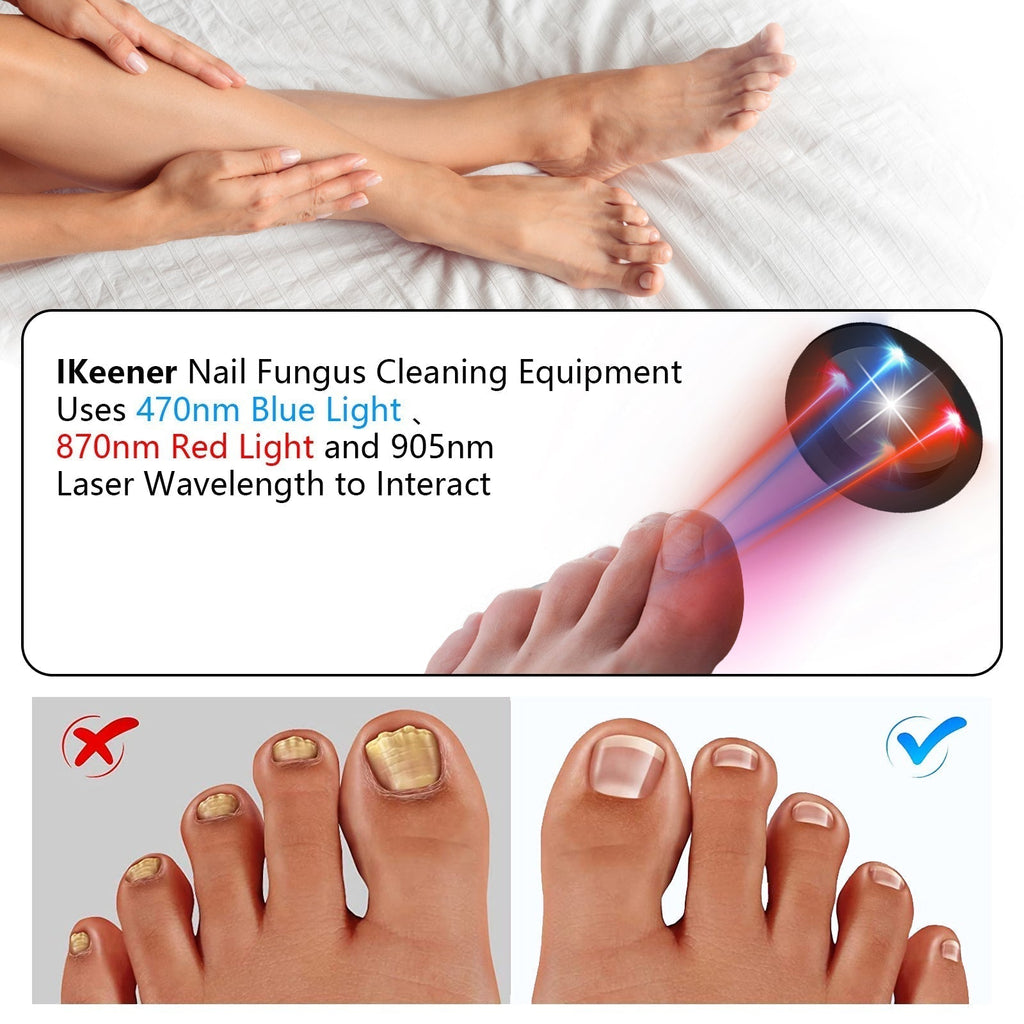 NailGuard Tåneglsopp Laserterapienhet for hjemmebruk